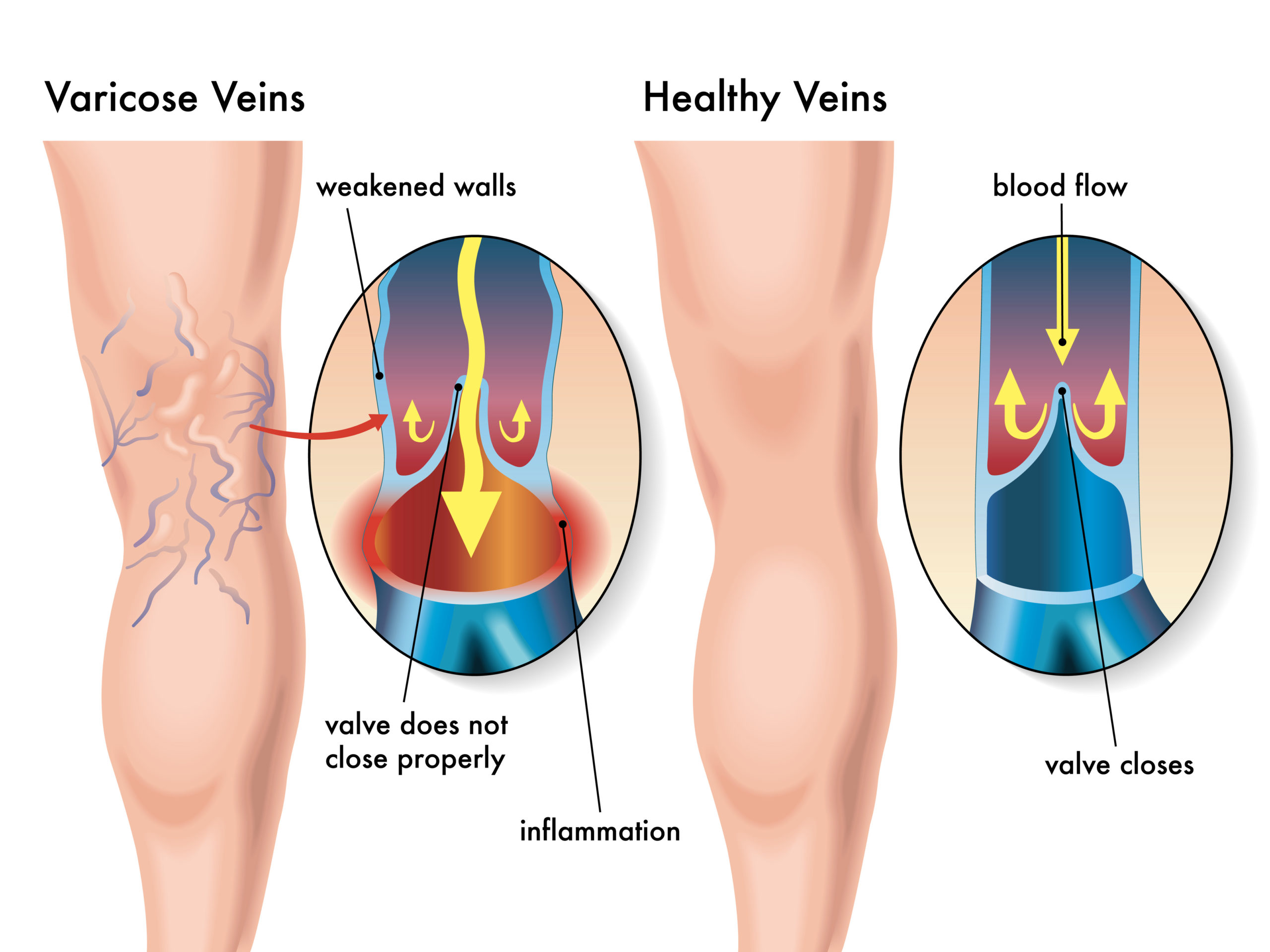 Insufficienza venosa: come riconoscerla e come intervenire