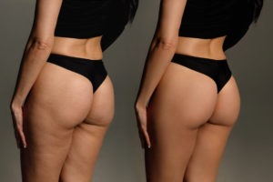 immagine di copertina per: 'Cellulite, scopriamo l’Orthosiphon'