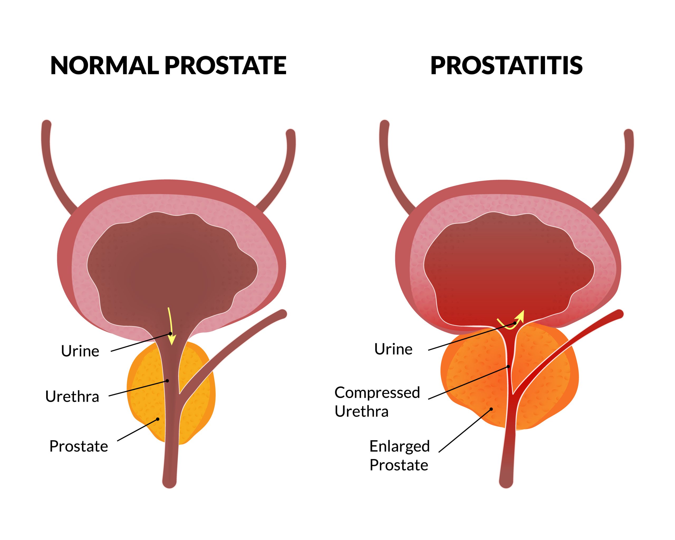 Ipertrofia prostatica benigna: le piante efficaci